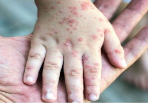 ایمن سازی کودکان علیه بیماری سرخک در سیستان و بلوچستان ضروری است